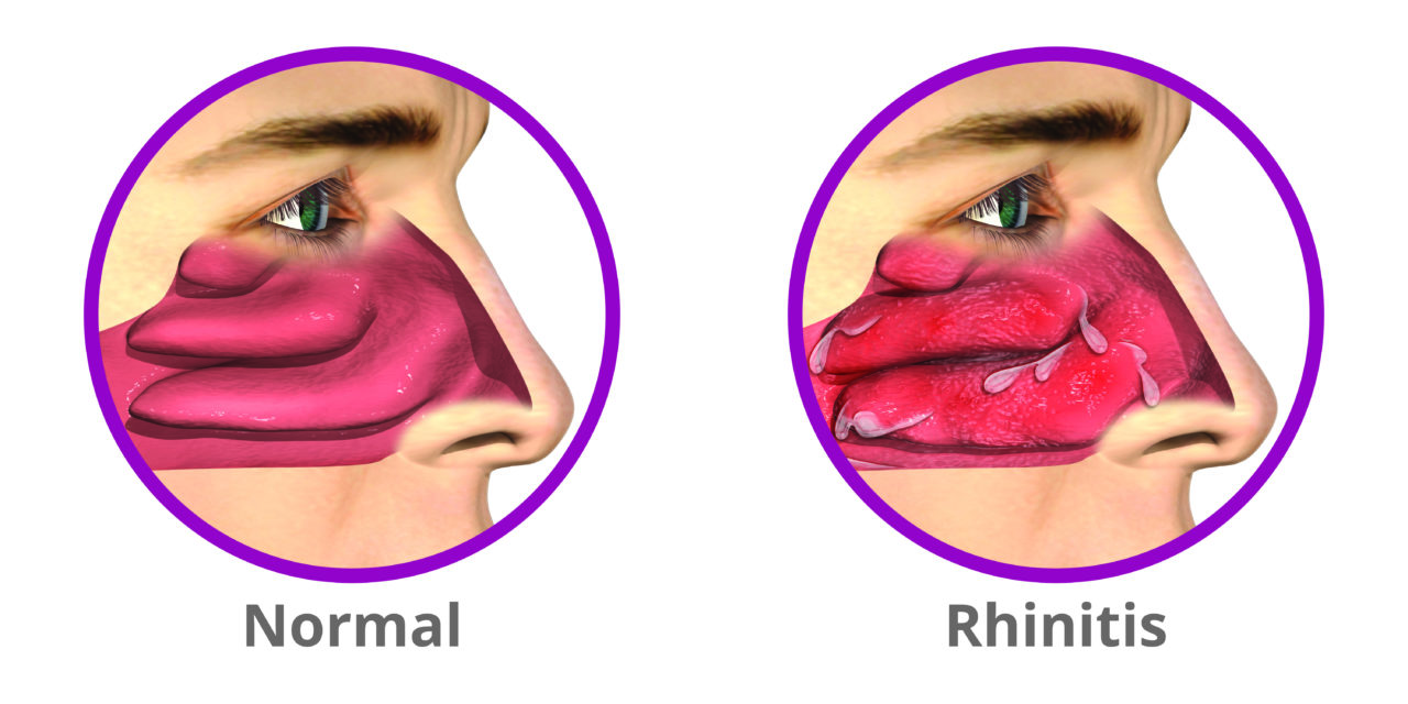 chronic-rhinitis-treatment-rhinaer-procedure